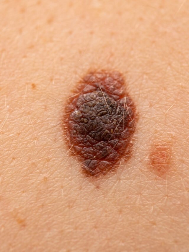 Dangerous nevus on skin - melanoma
