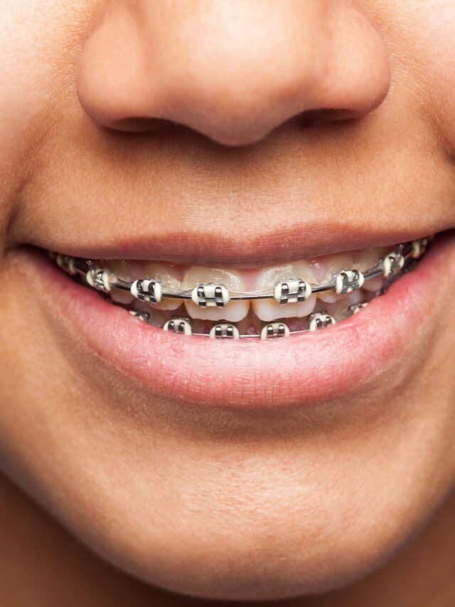 latin girl's mouth with brackets